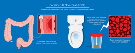 fecal occult blood tests
